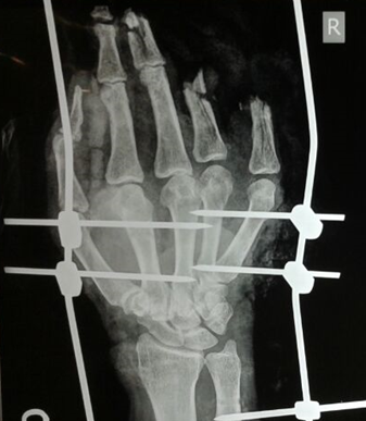 Hand Fracture Fixation
