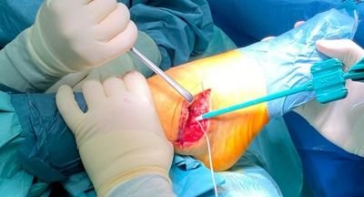 Complex Trauma Surgeries