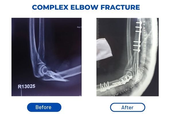 Fracture Aftercare Image 2