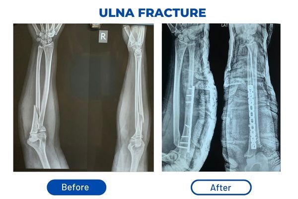 Fracture Aftercare Image 1