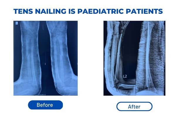 Fracture Aftercare Image 1