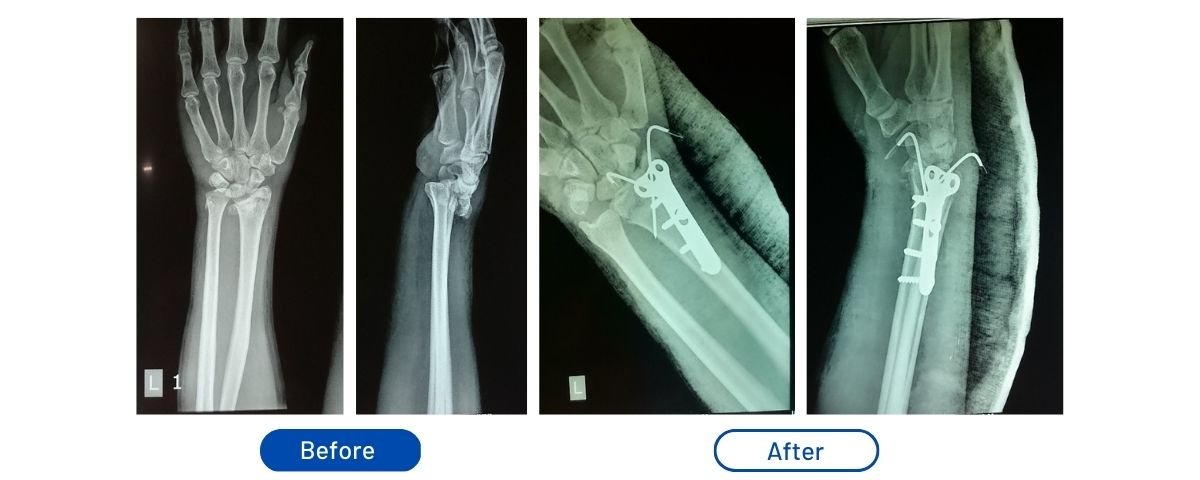 Dorsal Barton's Fracture
