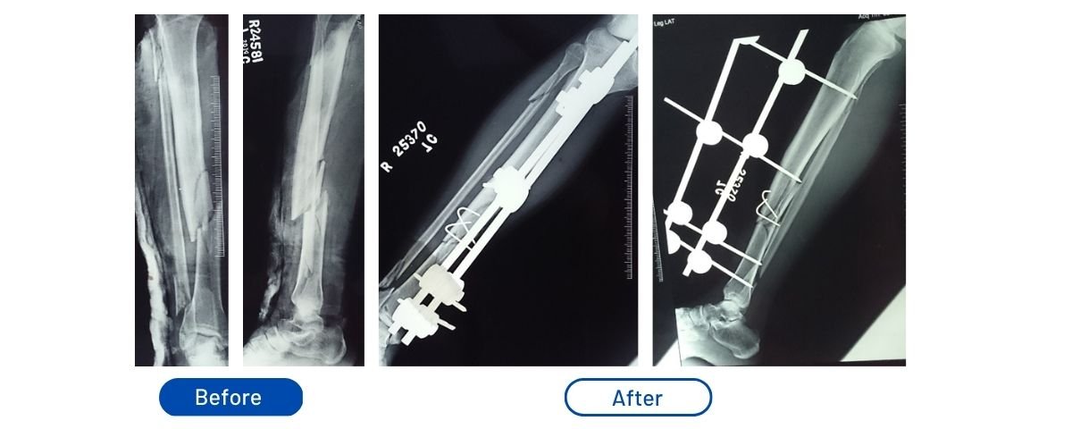 Comminuted Tibia Fracture
