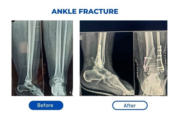 Fracture Aftercare Image 1