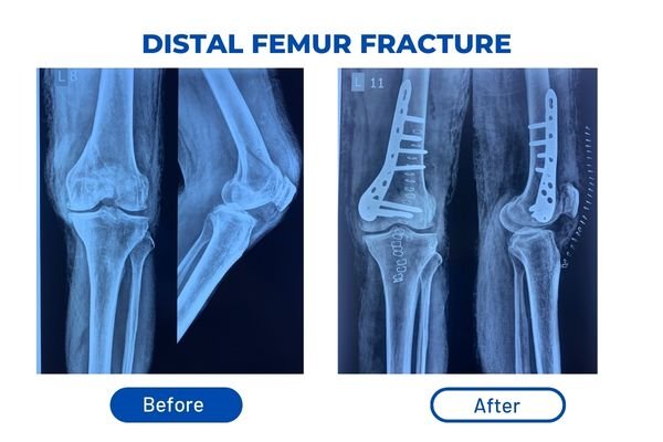 Fracture Aftercare Image 2