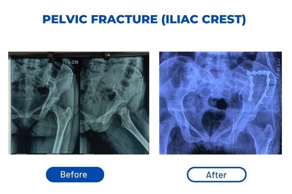 Fracture Aftercare Image 1
