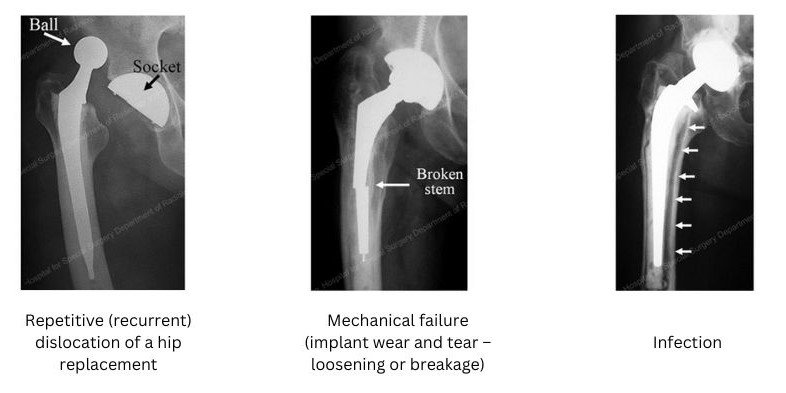 Revision Hip Surgery