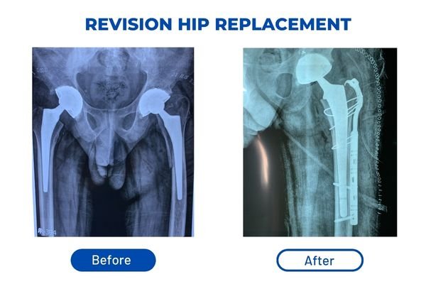 Revision Hip Surgery