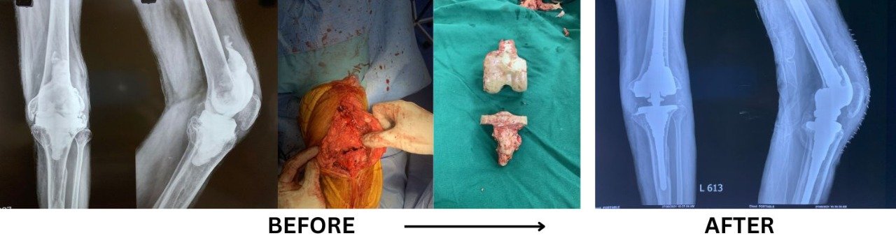 Revision Knee Surgery