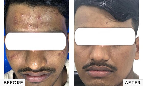 Hair Restoration Therapy