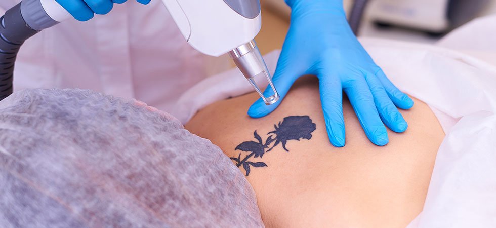 Tattoo Removal