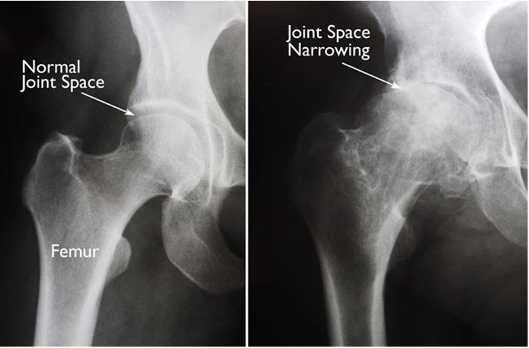 Post Surgery Activity