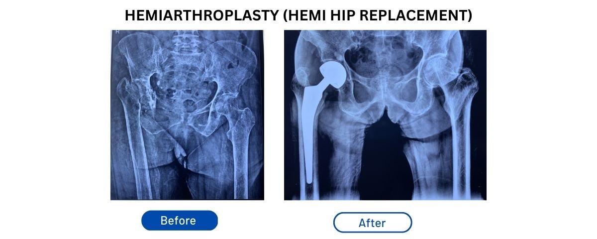 Post Surgery Activity